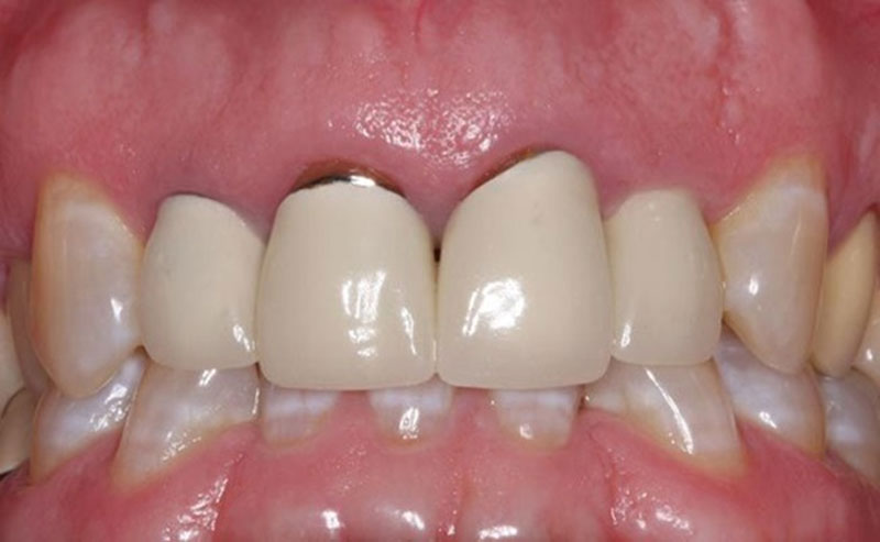 Sau bọc răng sứ có thể bị kênh cộm, hở chân răng nếu thực hiện sai kỹ thuật