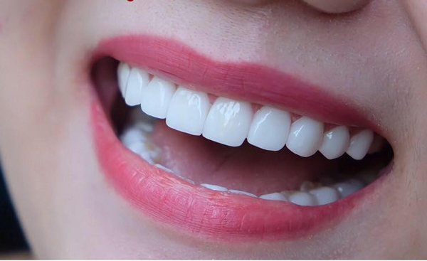 Lợi ích khi bọc răng sứ mà nhiều người chưa biết? White Clinic