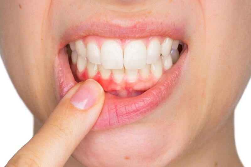 Cảm Giác Sau Khi Bọc Răng Sứ: Các Vấn Đề Thường Gặp Nhất