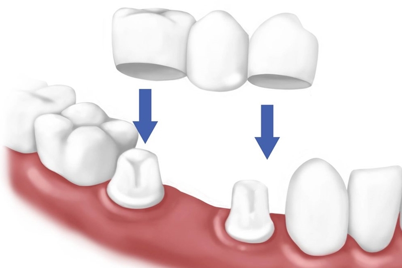 Làm cầu răng sứ - 7 thắc mắc thường gặp nhất khi | Nha Khoa Tân Định