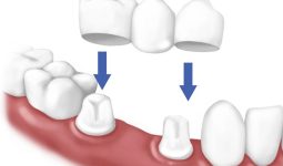 Làm cầu răng sứ - 7 thắc mắc thường gặp nhất khi | Nha Khoa Tân Định