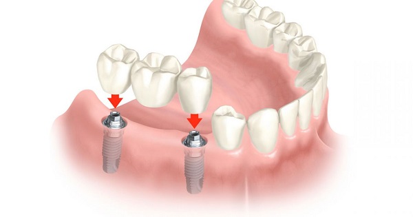 Phương pháp Implant là gì?