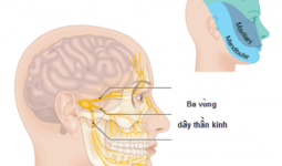  Khi dây thần kinh vận động ở mặt bị tổn thương sẽ gây ra tình trạng liệt dây thần kinh số 7 