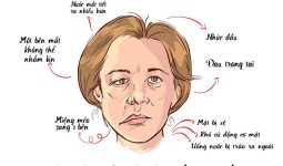 Các triệu chứng phổ biến của liệt dây thần kinh số 7 ngoại biên