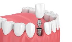 Phương pháp trồng răng Implant sử dụng kết cấu răng bao gồm 3 phần cơ bản là: Trụ Implant, mão răng sứ và khớp nối Abutment