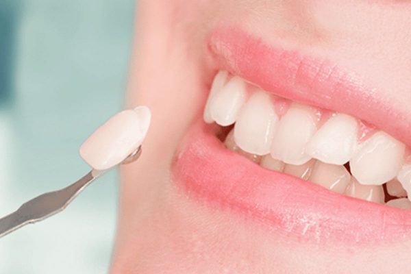 Chi phí dán răng sứ tại nha khoa bao nhiêu tiền?
