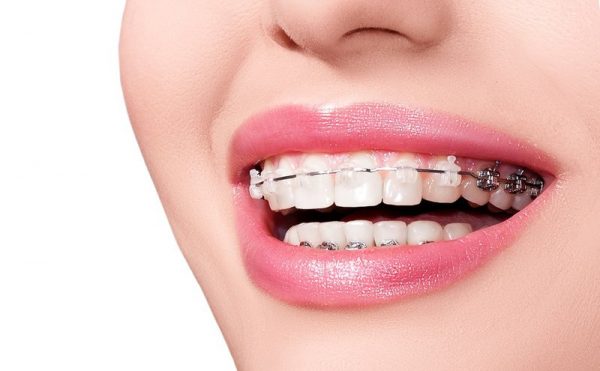 Phương pháp niềng răng bằng mắc cài sứ mang lại hiệu quả chỉnh nha lâu dài với rất nhiều những ưu điểm vượt trội