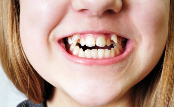 Răng mọc lộn xộn trên cung hàm có thể ảnh hưởng tới chức năng nhai cũng như thẩm mỹ cho khuôn mặt