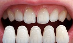Dán răng sứ là gì? Dán răng sứ có tốt không?