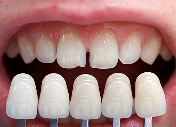 Dán răng sứ là gì? Dán răng sứ có tốt không?