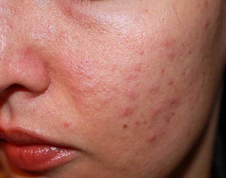 Dị ứng da mặt: Nguyên nhân, dấu hiệu nhận biết và cách điều trị