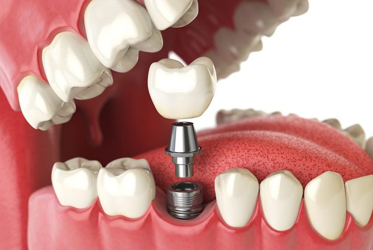 Top 10 Địa chỉ Trồng Răng Implant tại TPHCM tốt nhất 2023