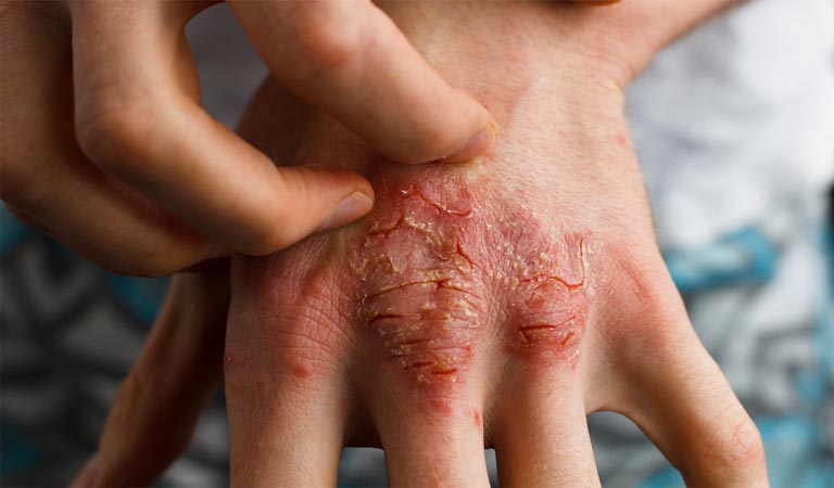 Bệnh eczema có chữa khỏi được không? bằng cách nào?
