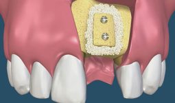 Tổng quan về kỹ thuật ghép xương trong cấy ghép răng implant -  nhakhoathuyanh