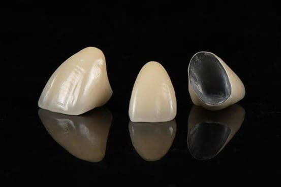 Răng sứ kim loại là gì? Ưu nhược điểm và giá cả bao nhiêu?