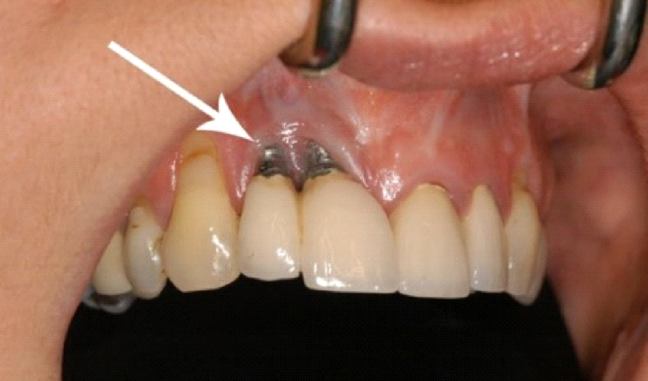 Răng implant bị đào thải có trồng lại được không? Quy trình xử lý như thế  nào? - nhakhoathuyanh