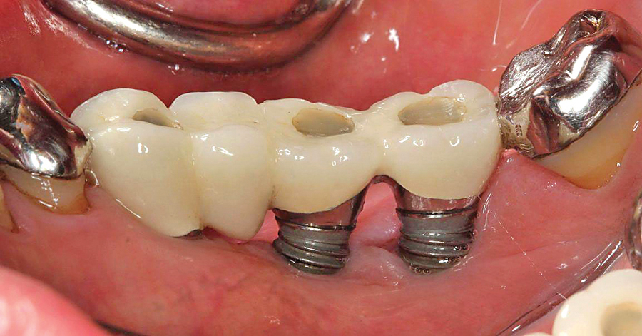 Dấu hiệu và cách khắc phục khi răng implant bị đào thải