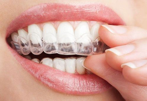 Niềng răng 3d Clear cài có tốt không, đặc điểm và giá niềng là bao nhiêu?