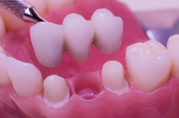 Mất Răng Số 7 Nên Làm Cầu Răng Sứ Hay Trồng Implant? - Nha khoa Delia