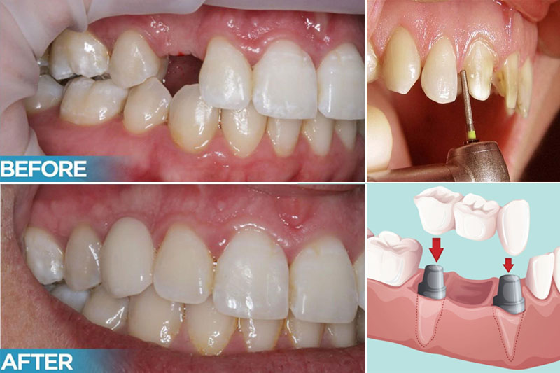 Cầu răng sứ cải thiện chức năng ăn nhai và tính thẩm mỹ hiệu quả