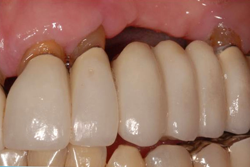 Cầu răng sứ vẫn xảy ra tình trạng tiêu xương hàm