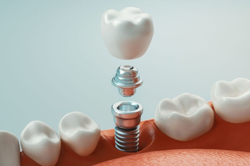 Trồng răng Implant phục hình từ chân răng, ngăn ngừa biến chứng tiêu xương