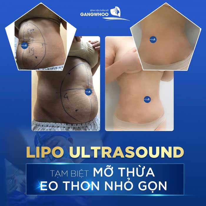 lipo ultrasound 2
