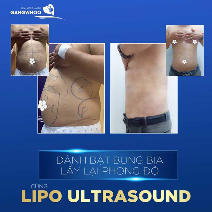 lipo ultrasound