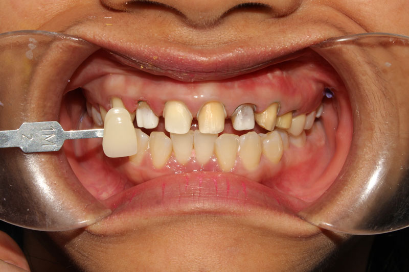 Trường hợp nào cần mài răng hô? Mài răng hô có hại không?