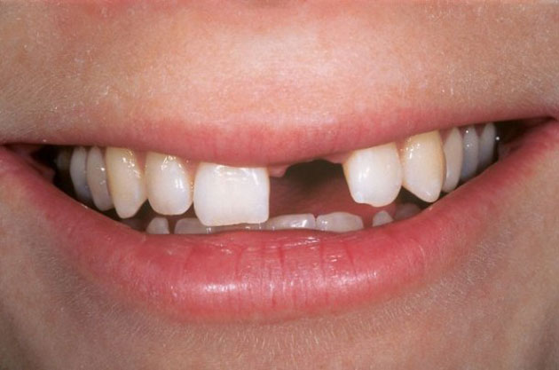 Bị mất răng cửa nên trồng răng theo cách nào? - Nhakhoadalat.vn