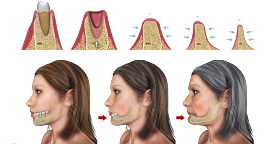 mất răng là nguyên nhân chính làm biến dạng khuôn mặt