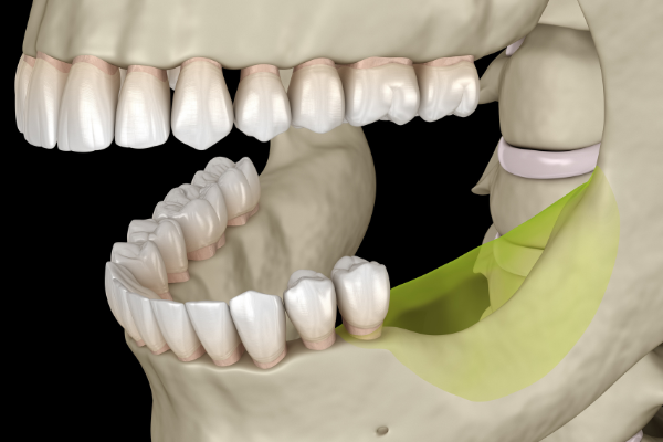 mất răng lâu năm thường dẫn đến tiêu biến xương hàm