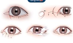 Công nghệ lấy mỡ mí mắt đem lại sự thay đổi kỳ diệu cho đôi mắt (*)