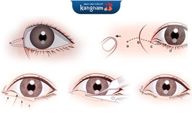 Công nghệ lấy mỡ mí mắt đem lại sự thay đổi kỳ diệu cho đôi mắt (*)