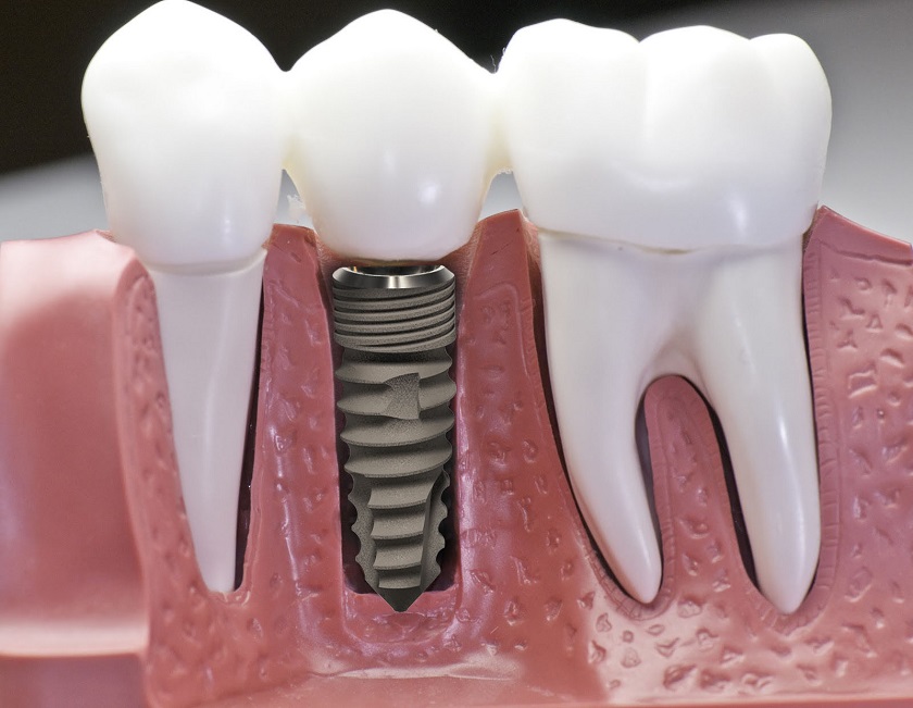 Phương pháp implant phù hợp để phục hình răng