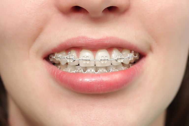 Niềng răng pha lê có kết quả phục hồi răng tốt, tính thẩm mỹ cao