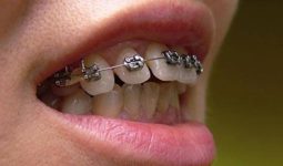 Niềng răng một hàm có được không, có mang lại hiệu quả không?