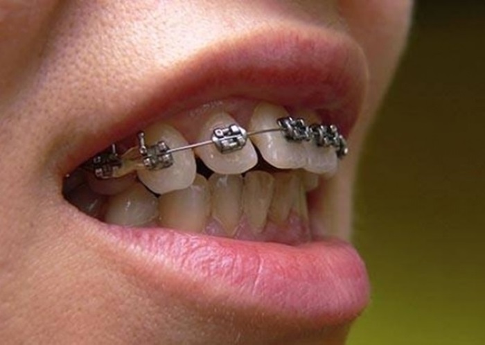 Niềng răng một hàm có được không, có mang lại hiệu quả không?