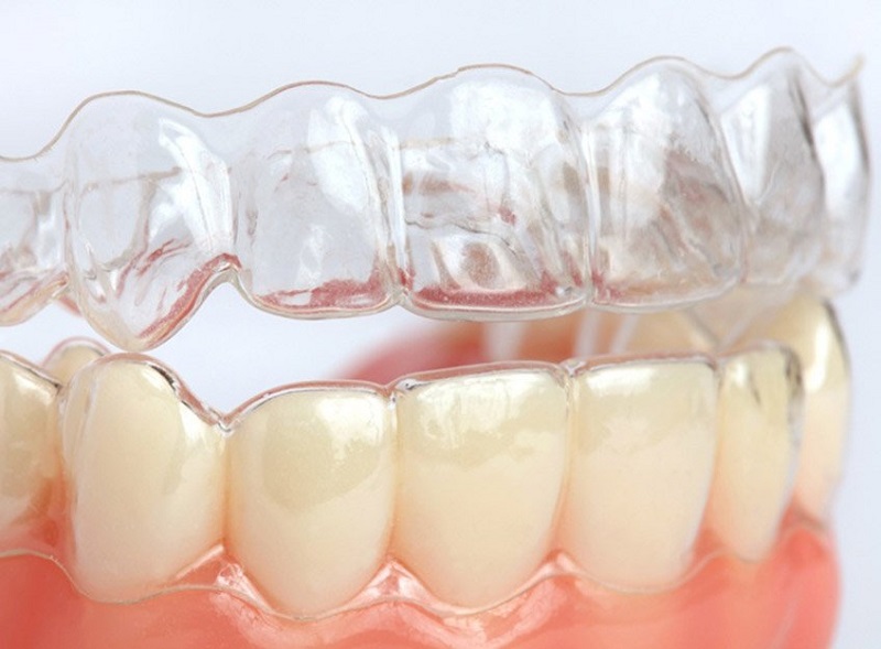 Niềng Răng Không Mắc Cài 3D Clear: Ưu Điểm, Quy Trình, Lưu Ý Niềng