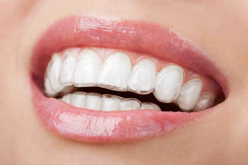 Công nghệ niềng răng 3D Clear được nhiều người tin dùng hiện nay