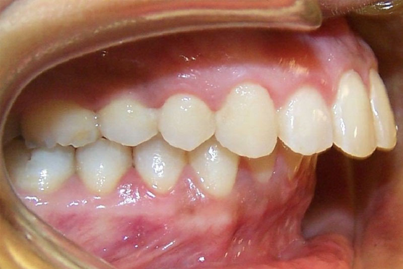 Răng sai lệch do cả hai hàm sẽ phải niềng răng 2 hàm để đạt hiệu quả tối ưu