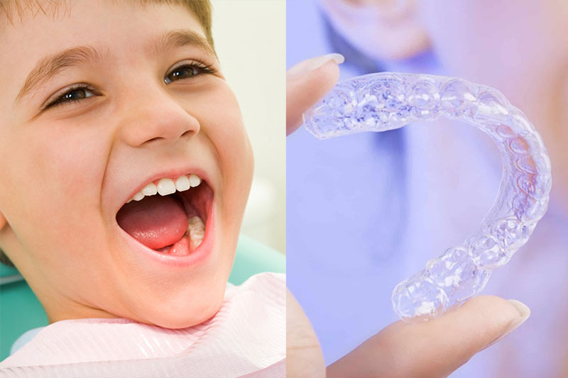 Niềng răng trong suốt cho trẻ nên thực hiện ở độ tuổi nào?