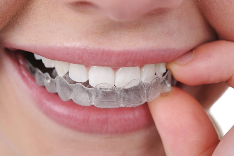 Niềng răng trong suốt cho trẻ nên thực hiện ở độ tuổi nào?
