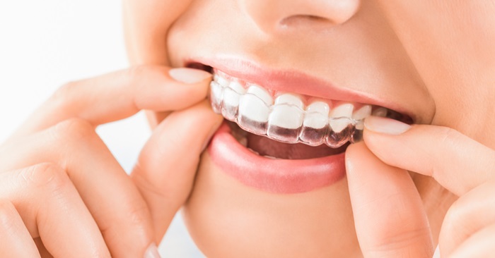 Niềng răng 3D Clear giá bao nhiên tiền? Mức giá chuẩn điều trị? 1