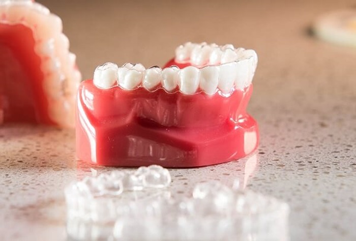 Niềng răng 3D Clear giá bao nhiên tiền? Mức giá chuẩn điều trị? 2