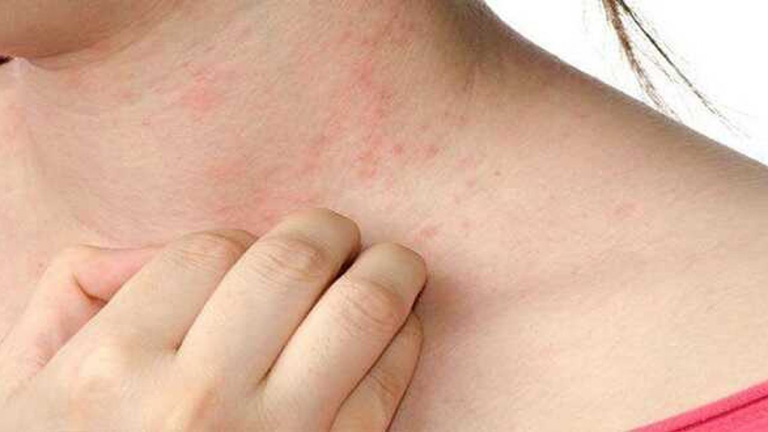 Không sốt nhưng nổi mẩn đỏ trên da là dấu hiệu ban đầu của bệnh ung thư da