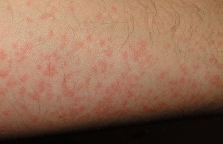Dị ứng thuốc có thể gây nổi mẩn đỏ trên da