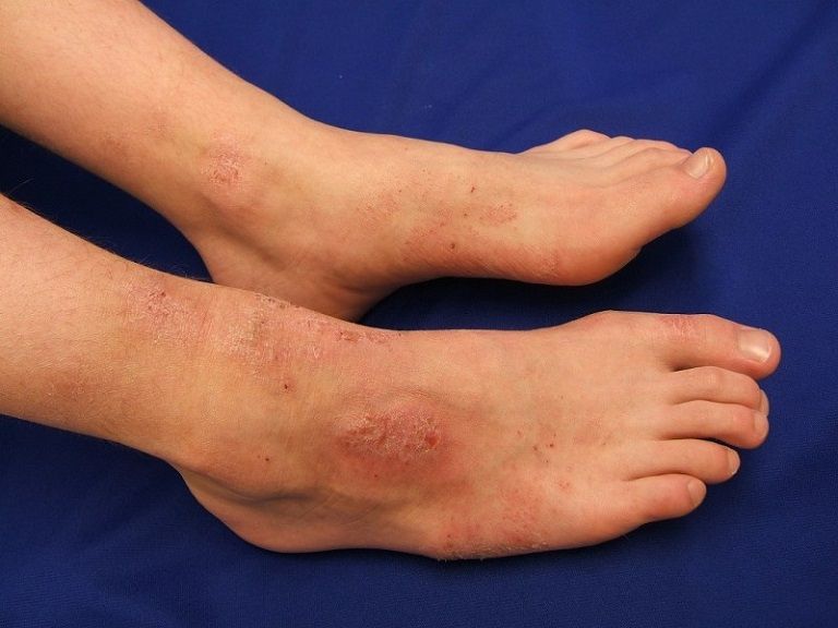 Nếu không chăm sóc đúng cách có thể để lại các vết sẹo ở chân rất mất thẩm mỹ