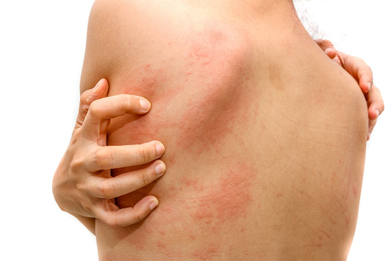 Mề đay (mày đay) là tình trạng dị ứng da, có tính phổ biến và do nhiều nguyên nhân gây ra