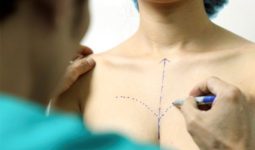 Phẫu thuật nâng ngực giúp chị em tự tin hơn?